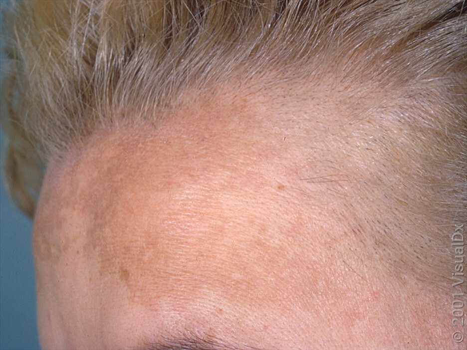 hyperpigmentation melasma on left forehead of caucasian person with blondish brown hair
